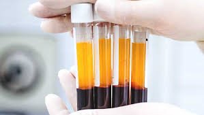 Platelet Rich Plasma: A Guide